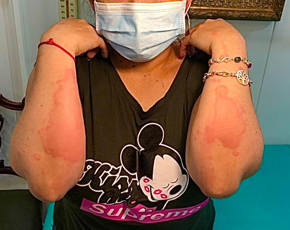 Urticaria demorada por presión